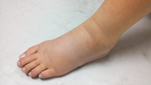 Leech Therapy Centre UK|Oedema